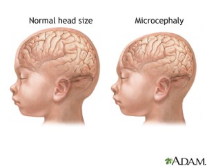 microcephaly