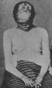 A woman with advanced porphyria- yikes!