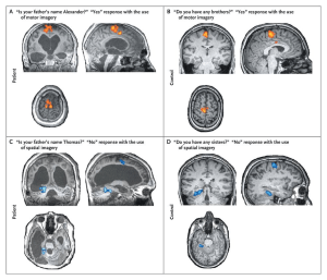 Figure 1. fMRI brain activation maps for a patient (A & C) and control participant (B & D) for a task that asked them to answer yes/no questions by imagining either a motor response (A & B) or spatial response (C & D). Initially, patients and controls underwent a task that asked them to imagine themselves either playing tennis (motor) or navigating the streets of their city (spatial map). During the question portion of the task participants would respond yes or no to questions by using the same type of imagining.