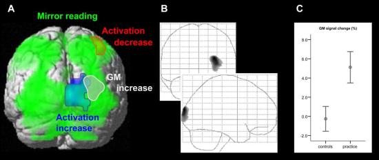 Figure 2. The green areas show areas of the brain active during mirror reading overall. The red region is the area that showed a decrease in activity after practice while the blue area is the region that showed an increase in activity after practice. The white region is the area that showed an increase in grey matter volume after practice. Notice that the white and blue area are partially overlapping.