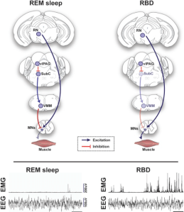 In RBD, the SubC neuron-VMM neuron connection may somehow be degraded. This would result in inappropriate muscle movement during sleep (as depicted by the spikes on the right electromyogram [EMG]), as compared to the stationary and stable sleep of normal individuals (shown by the lack of spikes on the left EMG).