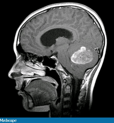 Cerebellar Tumor