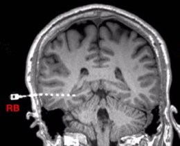 refractoryepilepsyyfig2_lg