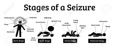 stages of seizure